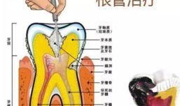 根管治疗视频,从视频学习根管治疗技巧与流程